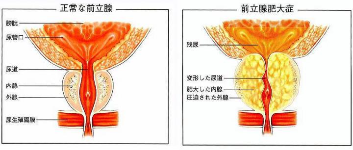 前立腺肥大症の数値が大幅に減った！