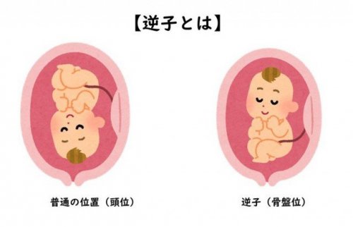 逆子でお悩みの方へ