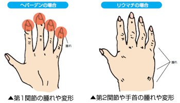 へバーデン・リウマチでお困りの方へ