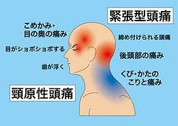 頭痛の種類と原因