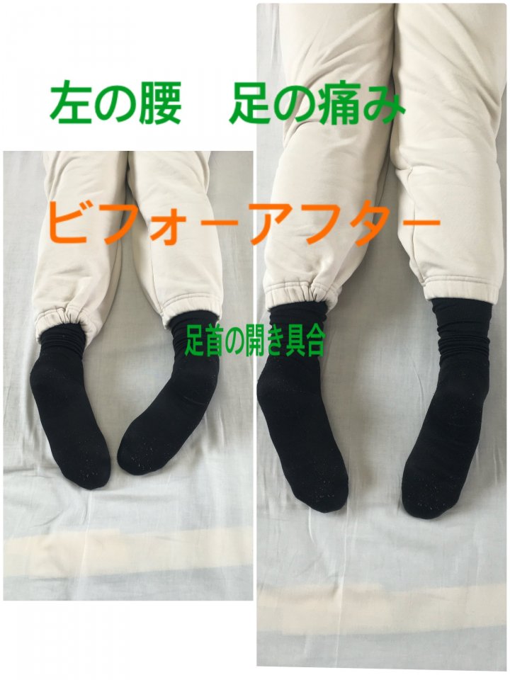 左の腰・足の痛みの原因は「足首の開き」と「足の長さの差」でした